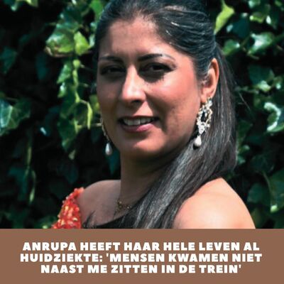 Anrupa heeft haar hele leven al huidziekte